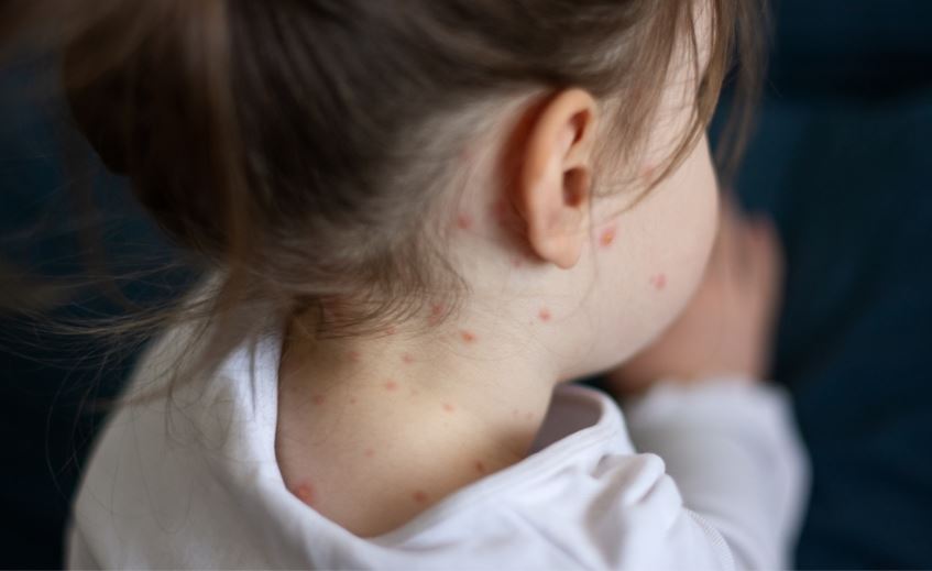 ولايتان الأكثر تضررًا.. ارتفاع حالات الإصابة بالحصبة في أمريكا إلى 317 حالة  
