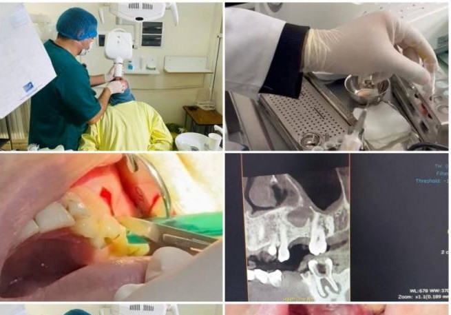 القصرين : نجاح طبي في ازالة ورم كيسي دون المساس بالجيوب الأنفية