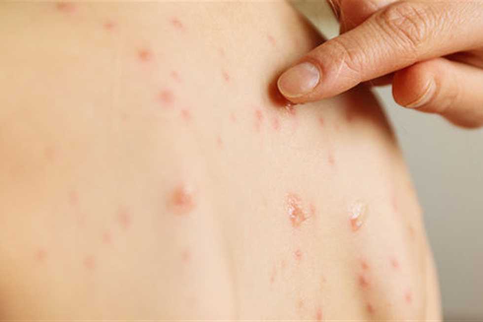 أمريكا تشهد أكبر موجة تفشٍّ للحصبة خلال 10 سنوات