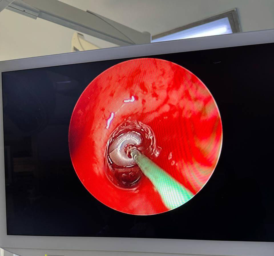 فريق طبي بمستشفى عبد الرحمان مامي ينجح في استخدام تقنيتي خزعة الرئة والتقليل بالتبريد لأول مرة بالمستشفيات العمومية