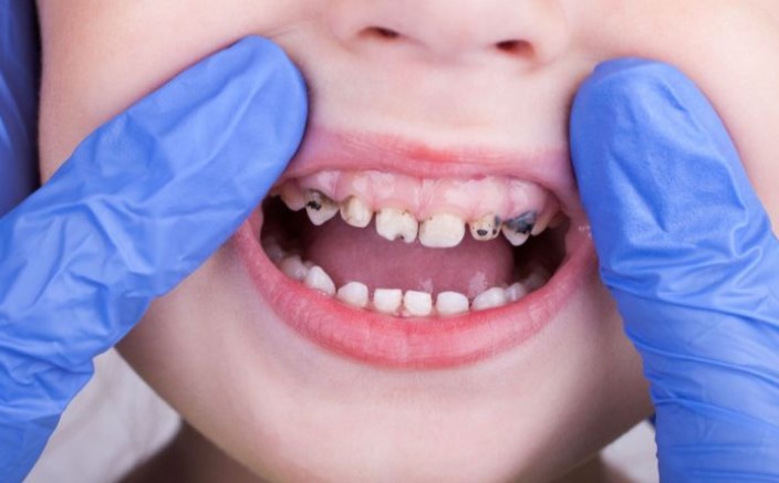 المنستير: رصد نسبة تسوّس تُناهز 80% خلال قافلة صحية حول صحة الفم والأسنان