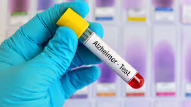 Alzheimer : La Tunisie bientôt dotée d’un test sanguin révolutionnaire pour un diagnostic précoce