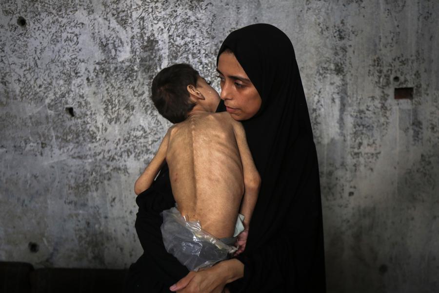العدوان الصهيوني على غزة : ارتفاع حصيلة وفيات المجاعة إلى 147 فلسطينيا من بينهم 88 طفلا