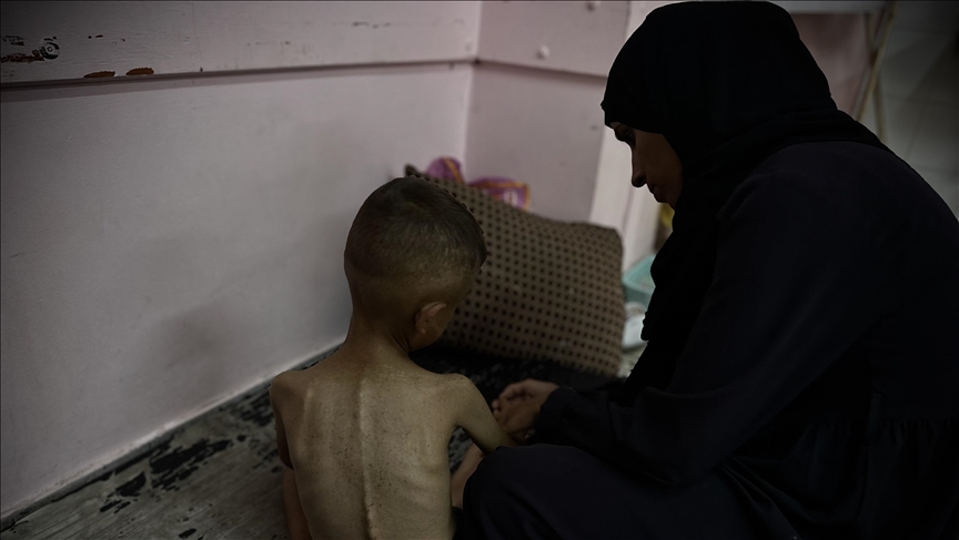 ارتفاع حصيلة الشهداء نتيجة التجويع وسوء التغذية إلى 455، من بينها 151 طفلا