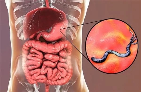 الدكتور مهدي قصيعة: 90% من التونسيين مصابون  بالبكتيريا الحلزونية وهذه مخاطرها وطرق الوقاية منها 