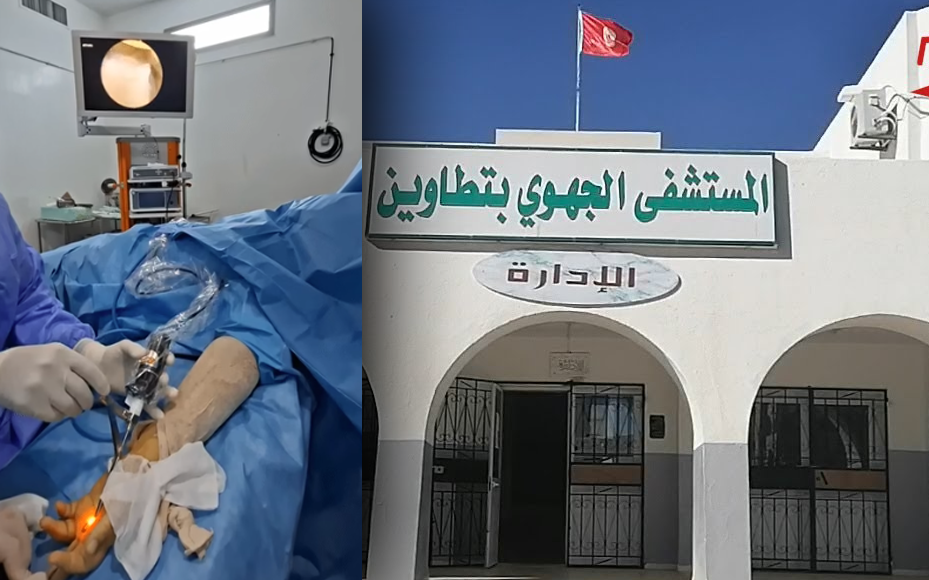 في تطاوين ولأوّل مرة في المسشفي الجهوي  اجراء عملية تحرير الأصبع لمريض بالمنظار 