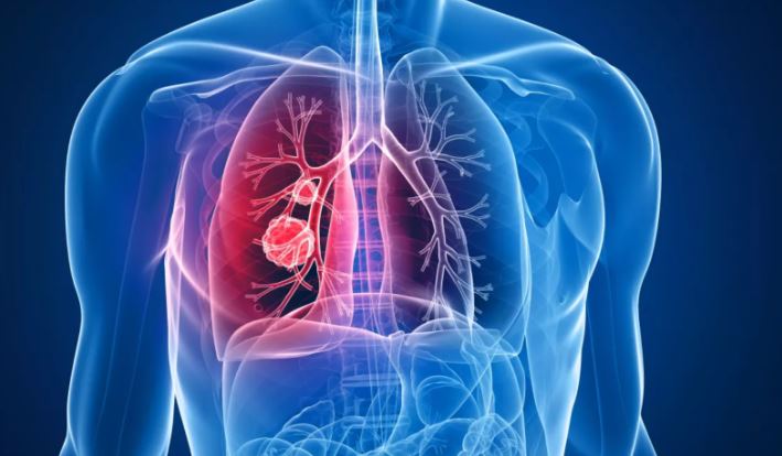 د. نسرين الماجري: تسجيل 3000 حالة إصابة بسرطان الرئة في تونس سنويا 60% منها في مرحلة متقدمة