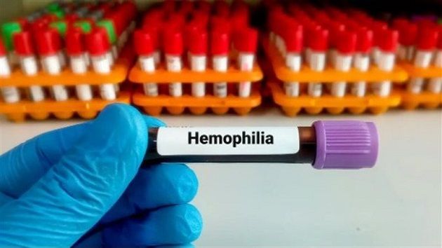 وزارة الصحة تبحث شراكة دوليّة لتحسين رعاية مرضى الهيموفيليا
