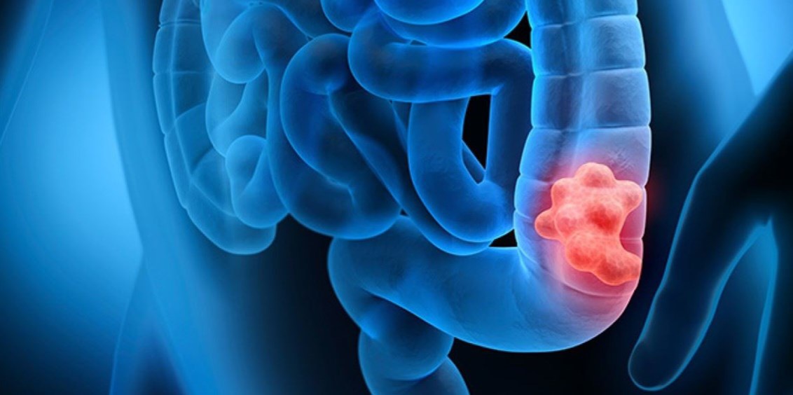 غدا.. حملة صحية مجانية للتقصي المبكر لسرطان القولون بالمسبح البلدي بباردو