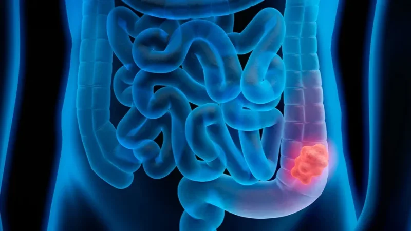 حملة صحية مجانية اليوم للتقصي المبكر لسرطان القولون بالمسبح البلدي بباردو