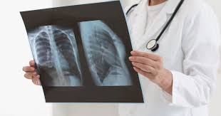 هيئة الصحة البريطانية تختبر الذكاء الاصطناعي لتسريع تشخيص سرطان الرئة