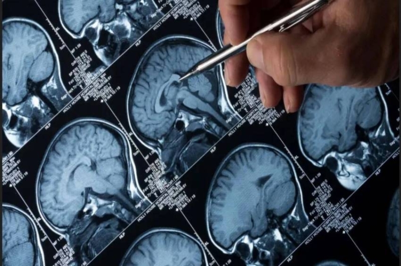 أستراليا تطلق تجربة سريرية رائدة لعلاج أورام الدماغ لدى الأطفال