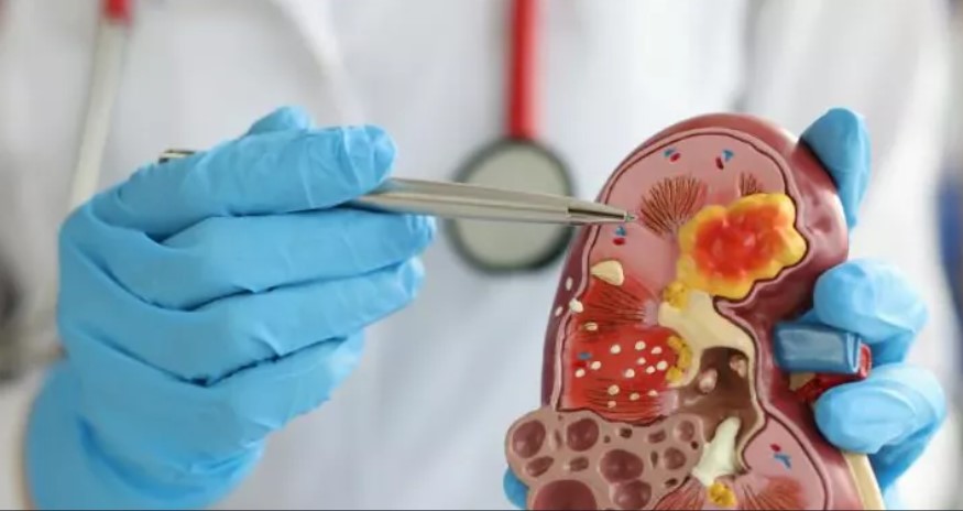  تقديم 112 عيادة مجانية بالمستشفى الجامعي ببن عروس بمناسبة احياء اليوم العالمي للكلى 