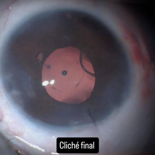 نجاح عملية جراحية دقيقة للعين بالمستشفى الجهوي بقابس