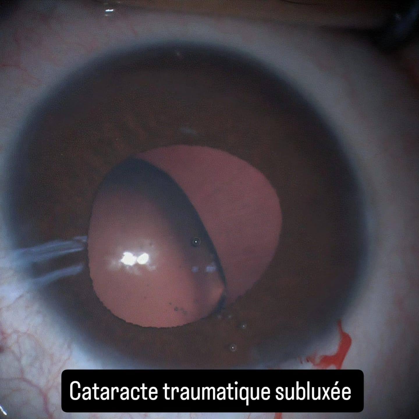 نجاح عملية جراحية دقيقة للعين بالمستشفى الجهوي بقابس