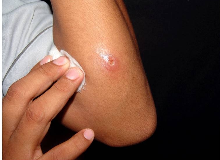 توزر: خطّة جهوية لمقاومة مرض اللشمانيا الجلدية 