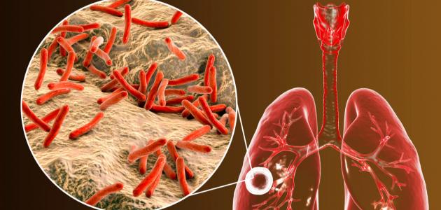  الدكتورة سنية معالج رئيسة قسم الأمراض الصدرية بـ مستشفى عبد الرحمان مامي : السعال المزمن يمكن ان يكون مؤشرا لمرض السل والتقصي المبكر يقي من تعكراته 