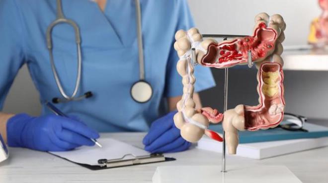 المعهد الوطني زهير القلال للتغذية يؤكد ان الوقاية من سرطان القولون والمستقيم تمرّ عبر تغذية متوازنة ونمط عيش صحي