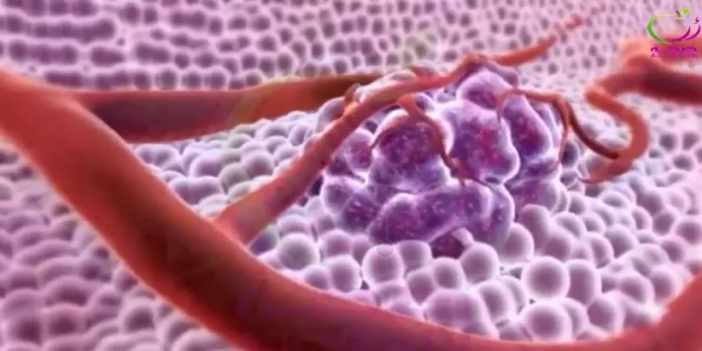 بتمويل أوروبي يُناهز مليون يورو: كلية الطب بسوسة تُطلق مشروعا للبحث العلمي في أمراض السرطان