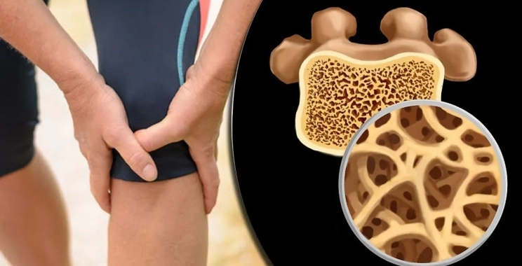 طبيبة مختصة : التقصي المبكر يمثل عاملا حاسما للشفاء التام من هشاشة العظام 