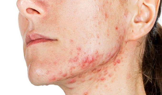 د.عايدة الزغلامي: المشاكل الجلديّة قد تكون مُؤشراً على الإصابة بعدّة أمراض خطيرة