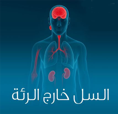 80 بالمائة من حالات الاصابة بمرض السل خارج الرئة لدى البشر متأتية من شرب حليب الأبقار غير المعقمة.