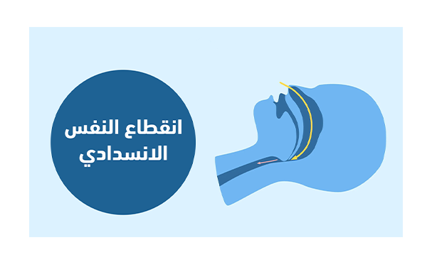 دعوة إلى إدراج متلازمة انقطاع النفس الانسدادي أثناء النوم ضمن معايير الأهلية الطبية للقيادة المهنية.