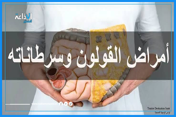 دراسة علمية: نجاح فحص الدّم في الكشف عن سرطان القولون.