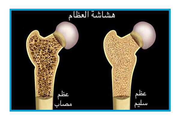 يوم تحسيسي حول هشاشة العظام بالمستشفى الجامعي منجي سليم بالمرسى.